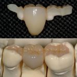 Composite_dental_bridge